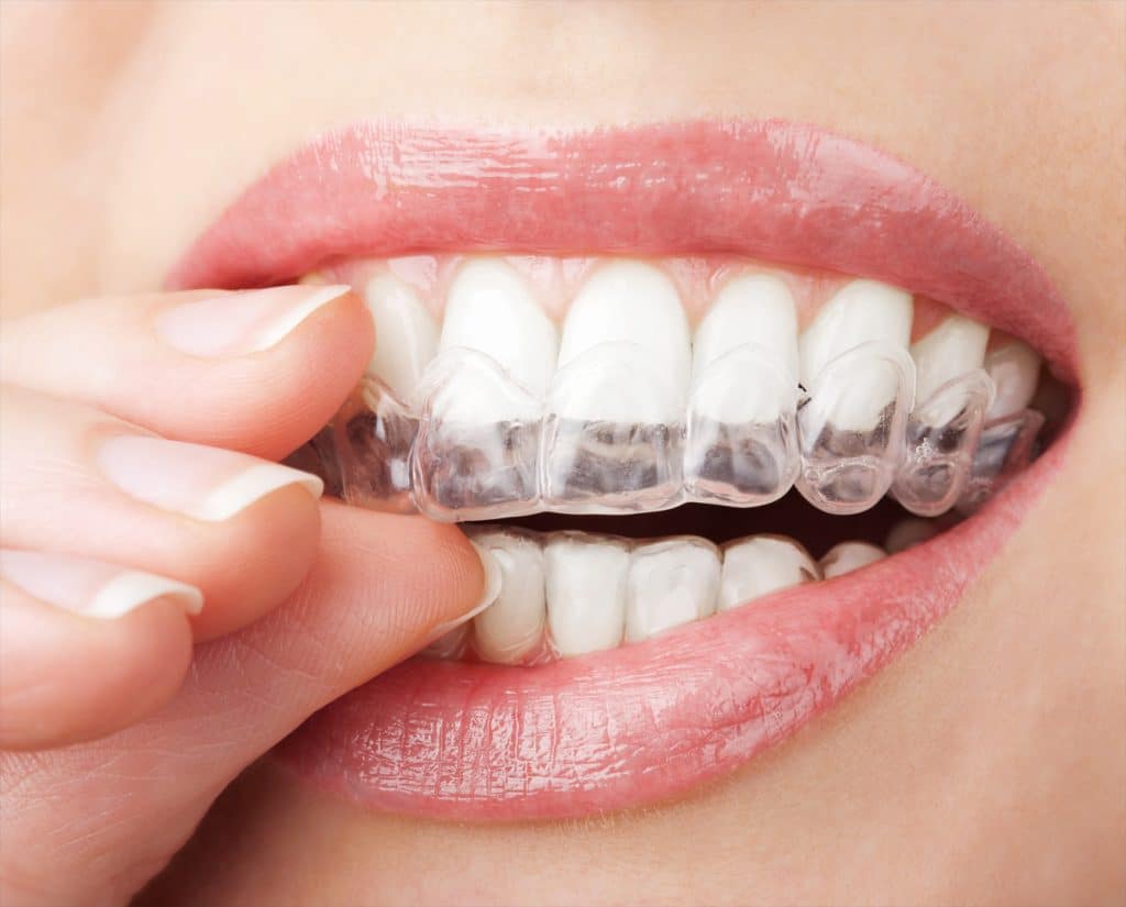 Invisalign Offers