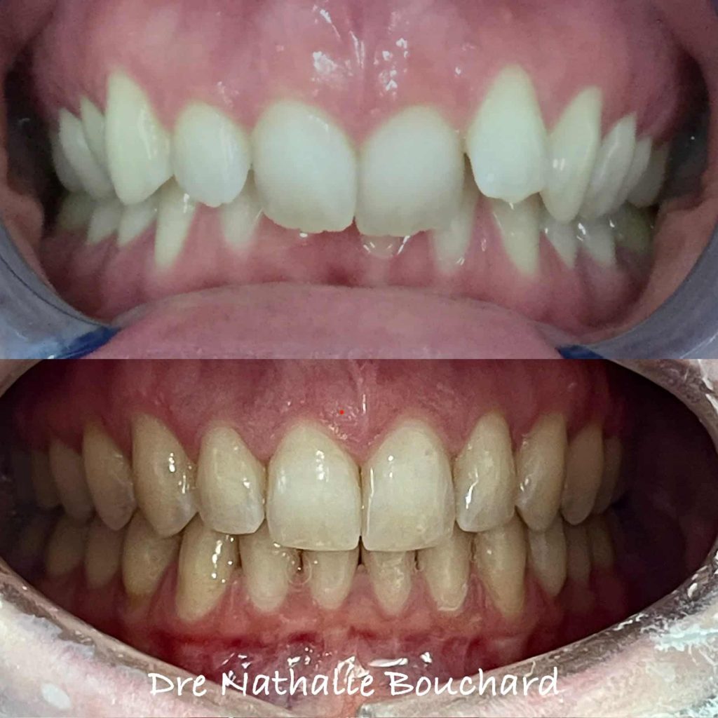 invisalign st-lambert