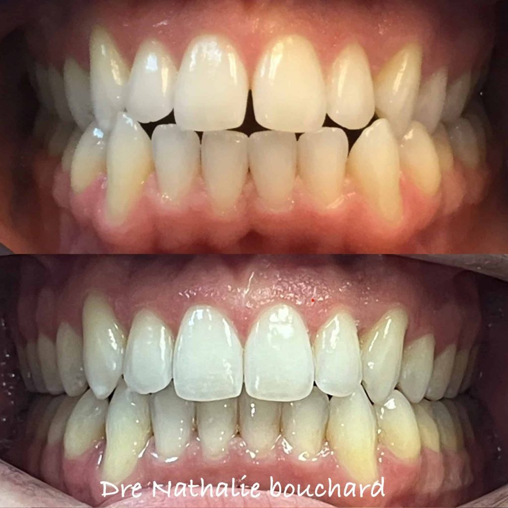 orthodontiste invisalign à St-Lambert